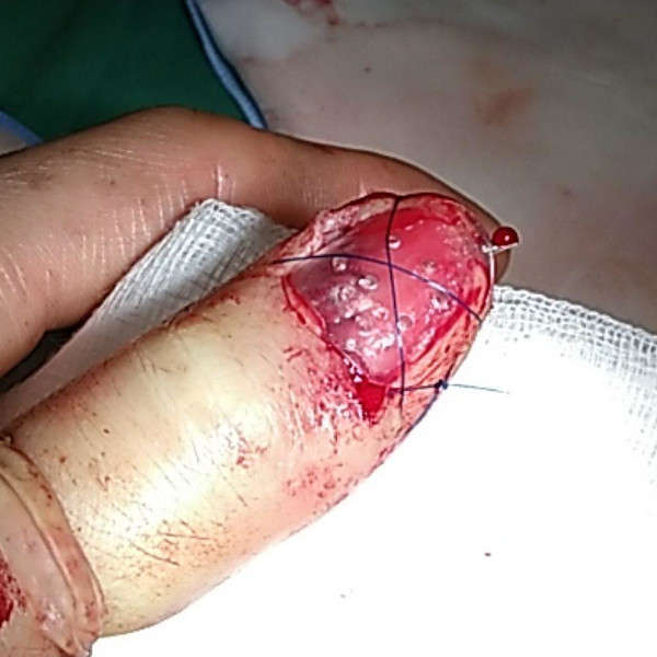 Mon nouvel ongle